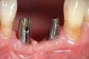 In die exakt passende Öffnung, die beim Spreading und Condensing entsteht, wird das Implantat eingebracht.