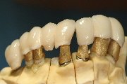 Festsitzende Kronen auf Zahnimplantaten