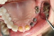 Individualisierte Implantataufbauten und präparierte OK-Zähne