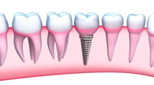 Periimplantitis