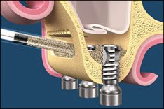 Bevor Implantate eingesetzt werden können, muss bei einigen Patienten ein Knochenaufbau erfolgen.
