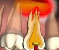 Wurzelspitze der Zähne