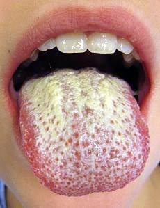 Soor ist eine spezifisch im Mundbereich auftretende Pilzinfektion, die besonders bei Babys und älteren Menschen entsteht