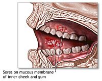 Oralverkehr mundsoor durch Pilzinfektion übertragung