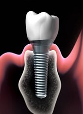Durch Studien an der Universität in Palermo konnten Zahnkronen auf Implantaten entwickelt werden, die Medikamente automatisch abgeben. 