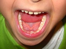 Gesunde Kinderzähne durch zahnärztliche Behandlung