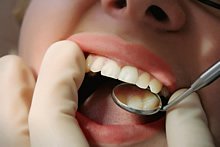 Eine Zahnfüllung wird bei Karies eingesetzt, einer der häufigsten Zahnbehandlungen.