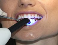 Durch das beschleunigende UV-Licht, kann die Prozedur des Zahnbleachings beschleunigt werden, was die Zähne schont.