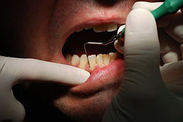 Zahnfleischtaschen und ihre Folgen sind in der Bevölkerung sehr verbreitet. Die Prophylaxe ist aber für jeden einfach umzusetzen.