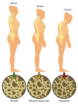 Viele ältere Menschen erkranken an der Volkskrankheit Osteoporose. Sie führt zu Knochenschwund im ganzen Körper, somit auch im Kieferbereich.