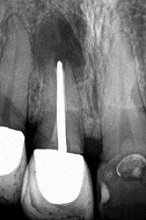 Ostitis am Wurzel-behandelten Zahn