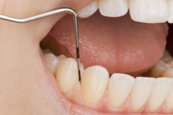 Es gibt verschiedenste Möglichkeiten der Parodontalchirurgie, die vom Zahnarzt individuell auf den Zustand des Zahnfleischs geplant werden.