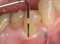 Um die Taschentiefe zu messen, nutzt der Zahnarzt eine Parodontalsonde. Über 2mm gilt sie als behandlungsbedürftig.