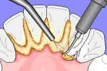 Die Entferung von Zahnstein ist mit herkömmlichen Zähneputzen nicht zu beseitigen.