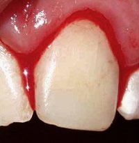 Mithilfe einer speziellen Untersuchung kann der Zahnarzt die Blutungsneigung Ihres Zahnfleischs untersuchen.