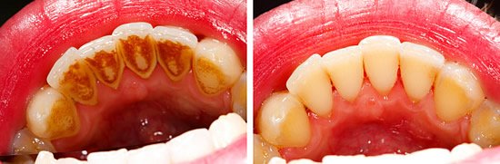 Durch angemessene Mundhygiene und den Verzicht auf verfärbende Lebensmittel können äußere Verfärbungen der Zähne vermieden werden.