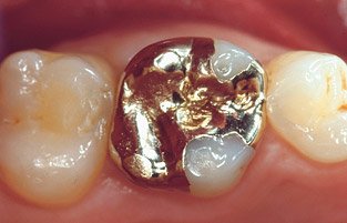 Zahnkrone aus Gold