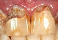Kariöse Zähne für Zahnkrone