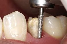 Präparation beim Zahnarzt