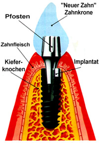 Ankylos Implantat-Aufbau