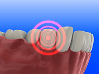 Entzündungen können zum Verlust der künstlichen Zahnwurzeln führen