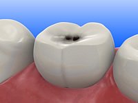 Karies zerstört die Zähne