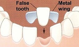 Klebebrücken werden oft bei jungen Patienten eingesetzt, bei denen ein Abschliff des Zahn nicht möglich ist.