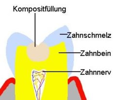 Komposit & Zahn in schematischer Darstellung