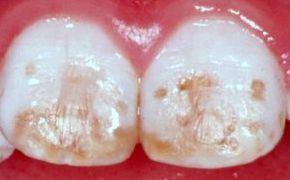 Kreidezähne der vorderen Zähne beim Kind