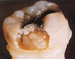 Loch im Zahn infolge von Karies
