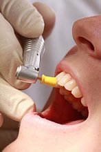 Die professionelle Entfernung durch den Zahnarzt durch eine professionelle Zahnreinigung