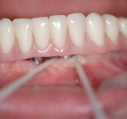Zahnseide in der Anwendung