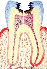 Eine Pulpitis, verursacht durch tiefe Karies, kann eine Behandlung der Zahnwurzel erforderlich machen.