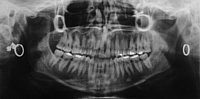Es gibt verschiedene Vorsorgebehandlungen beim Zahnarzt. Im Rahmen der Fissurenversiegelung werden schwer zu erreichende Grübchen der Backenzähne versiegelt.