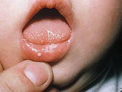 Kleindkinder sind sehr häufig vovom Pilz Candida betroffen, da ihr Immunsystem noch nicht voll ausgebildet ist und sie viele Gegenstände in den Mund nehmen.