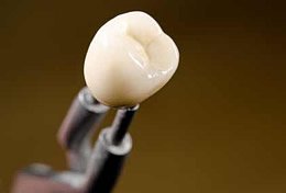 Bei starken Schäden am Zahn werden Keramikkronen eingesetzt, die auf die angeschliffene Zahnsubstanz aufgebracht werden.