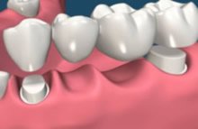 Zahnbrücke als Ersatz von vier Zähnen