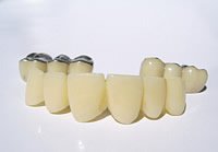 Eine Zahnbrücke dient als Zahnersatz und ermöglicht es, größere Lücken im Gebiss zu verschließen.