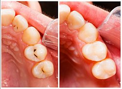 Eine der häufigsten Zahnkrankheiten ist die Karies. Sie entsteht durch Bakterien, die in Verbindung mit Sauerstoff den Zahnschmelz angreifen. 