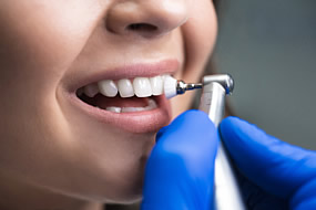 Eine regelmäßige professionelle Zahnreinigung beim Zahnarzt wirkt unterstützend, da Beläge entfernt und die Zahnoberfläche glatt poliert werden.