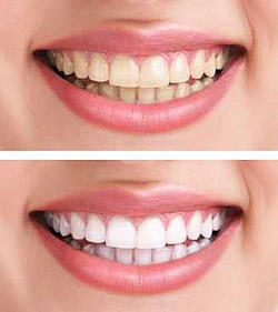 Die Schleifpartikel in Zahnweiß Zahnpastas schädigen den Zahnschmelz und können so der Entwicklung von Karies über kurz oder lang Vorschub leisten.