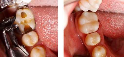 Zahnzement eignet sich gut für vorübergehende Füllungen, die wegen wiederholter Behandlungen leicht wieder zu entfernen sein sollte.