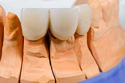 Zahnkronen aus Zirkon im Frontzahnbereich des Oberkiefers als ästhetischer Zahnersatz