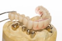 Das Zahnschema ist auch für Zahnersatz nicht mehr weg zu denken. Der Zahnarzt kann für den Zahntechniker genau die Zähne festhalten, die ersetzt werden müssen.