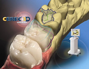 Cerec - 3-D Keramik