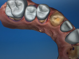 CEREC im Model