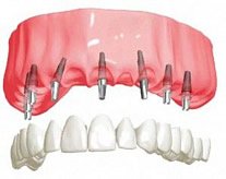 Leider gibt es keinen festsitzenden Zahnersatz bzw. Zahnimplantate mit Kronen und Brücken zum Nulltarif.
