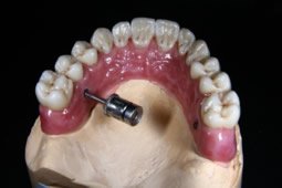 Festsitzende Zahnprothesen sind oftmals eine Erleichterung