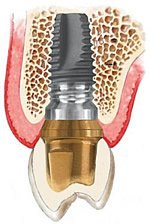Implantat mit Zahnkrone