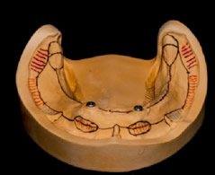 Der Wunsch der Patienten nach einer optimalen Versorgung seiner verlorengegangenen Zähne durch Zahnimplantate steht immer im Vordergrund. 